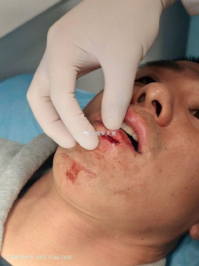 记者：王刚伤情比想象中好，侯森缝了20多针坐火车返京